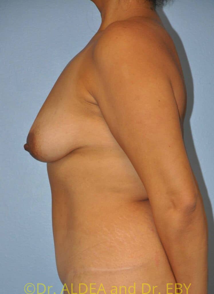 Before Image: Breast Augmentation w/ Lift #509 - left-side