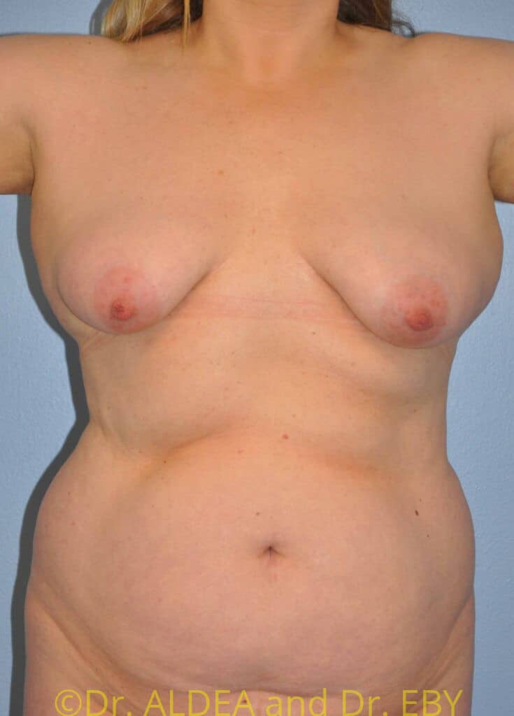 Before Image: Liposuction #583 - front
