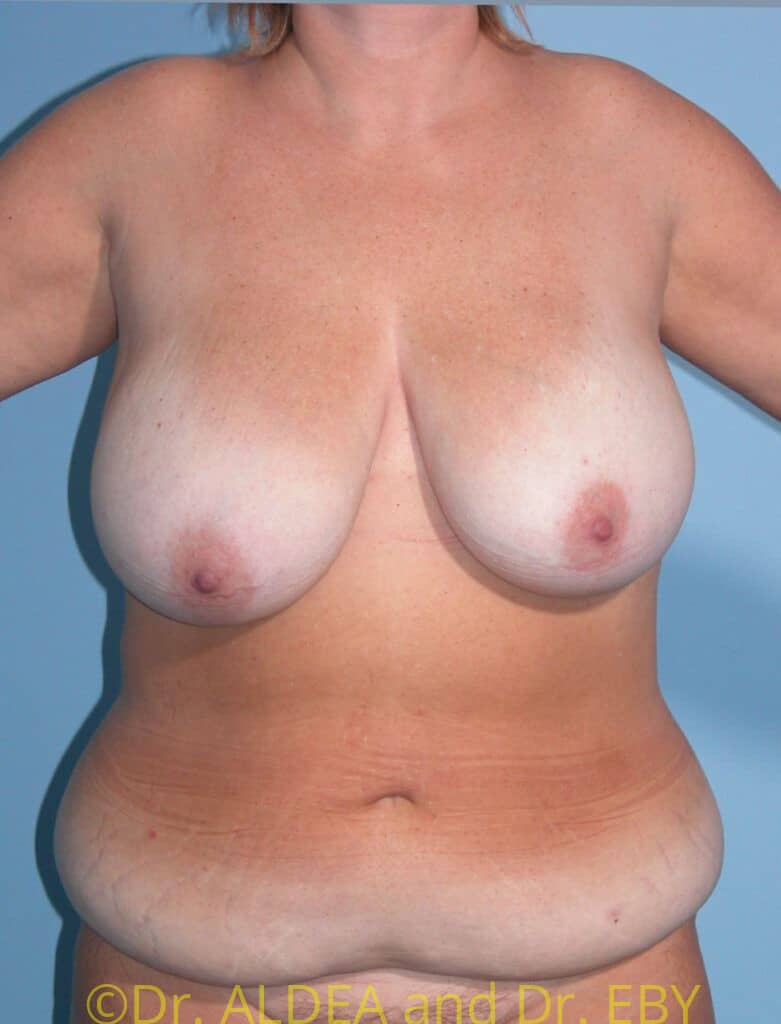 Before Image: Tummy Tuck #131 - front