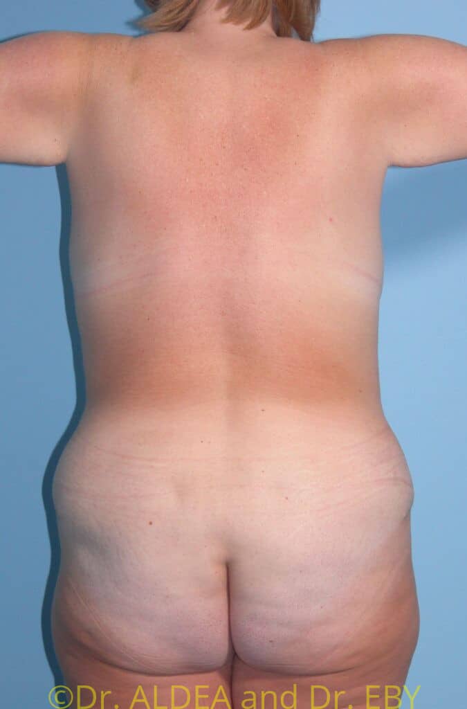 After Image: Tummy Tuck #131 - back