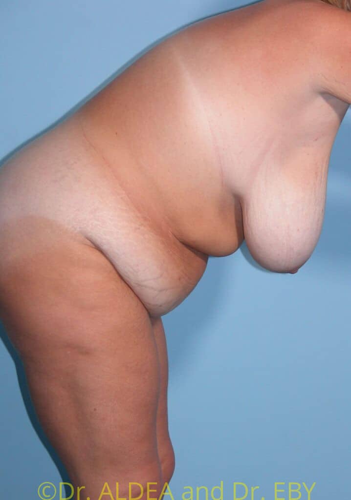 Before Image: Tummy Tuck #131 - other