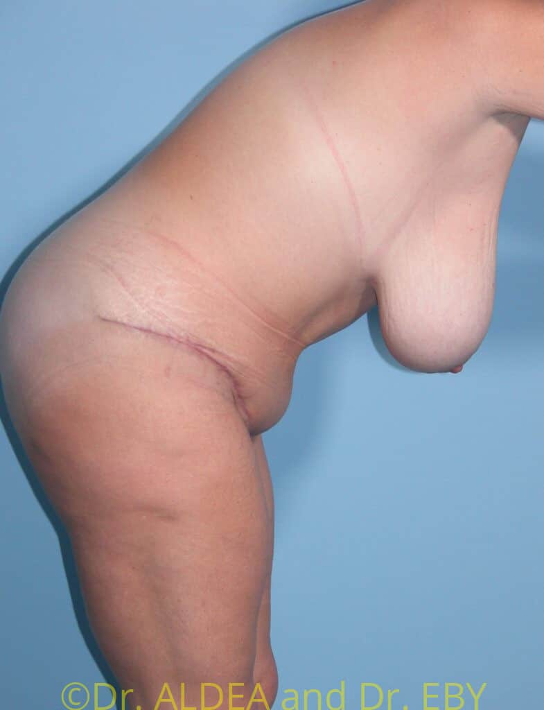 After Image: Tummy Tuck #131 - other