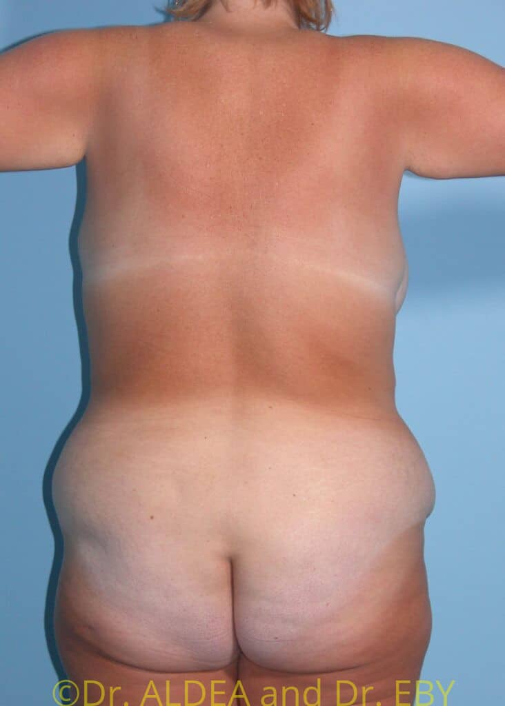 Before Image: Tummy Tuck #131 - back