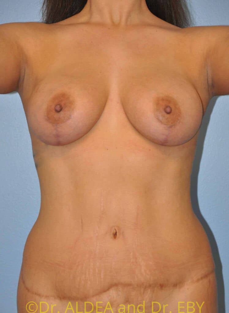 After Image: Breast Augmentation w/ Lift #962 - front