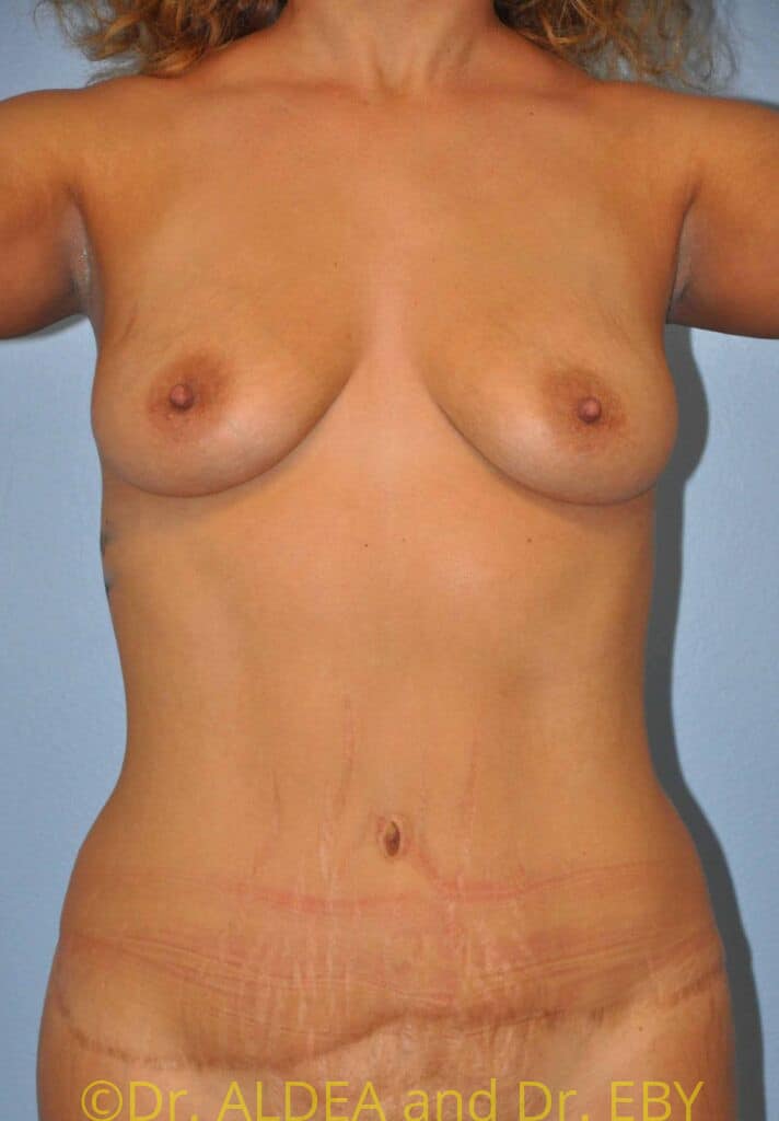 Before Image: Breast Augmentation w/ Lift #962 - front