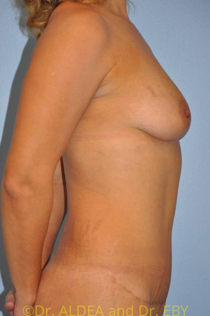 Before Image: Breast Augmentation w/ Lift #962 - right-side