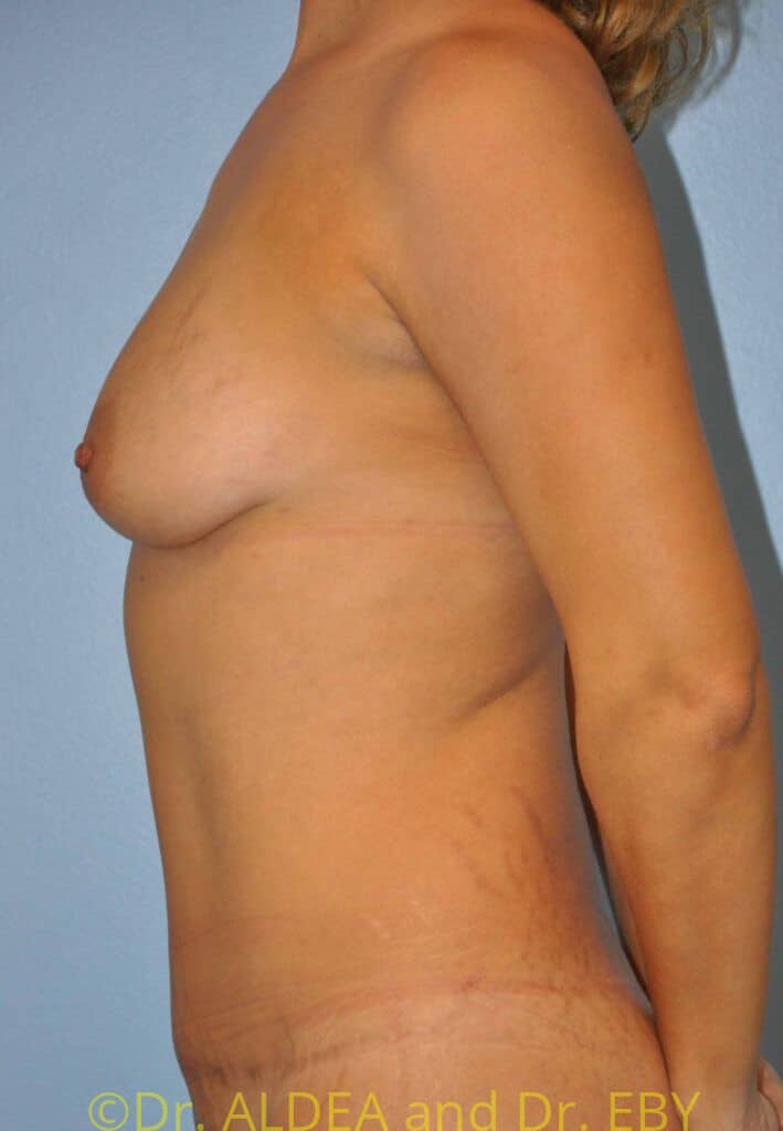Before Image: Breast Augmentation w/ Lift #962 - left-side