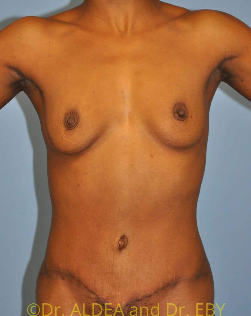 After Image: Tummy Tuck #783 - front