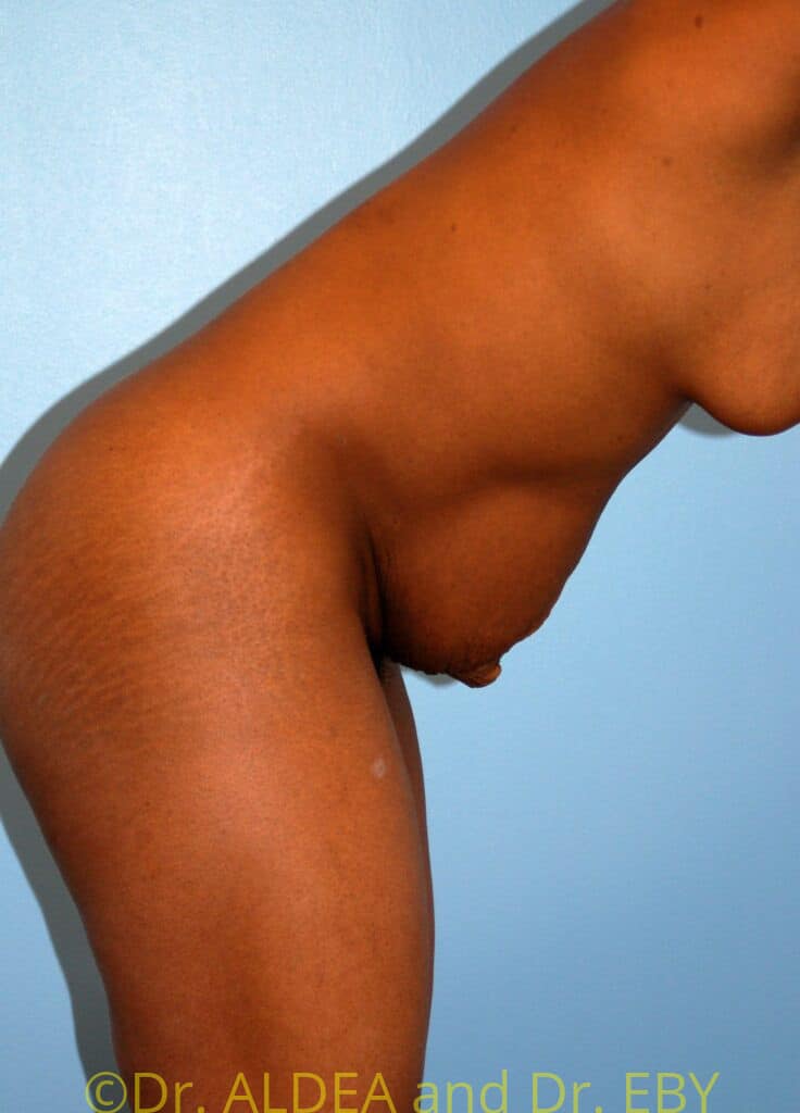 Before Image: Tummy Tuck #783 - other
