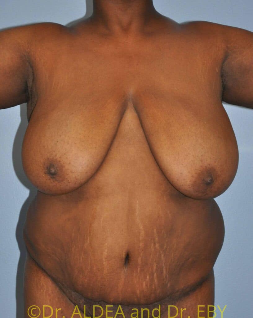 Before Image: Liposuction #354 - front