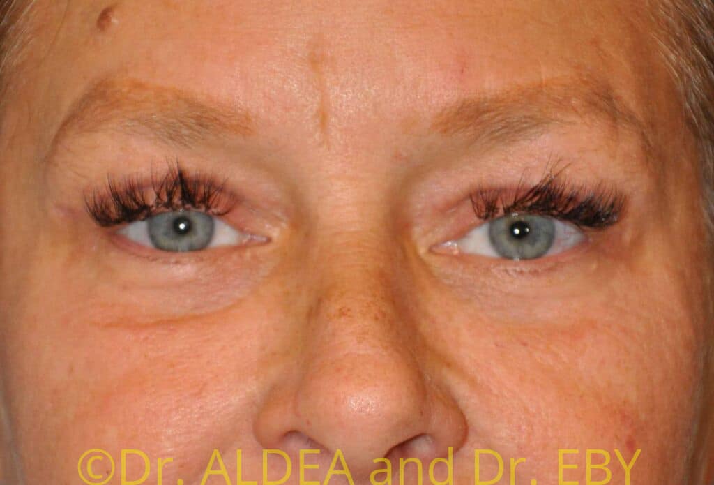After Image: Blepharoplasty #075 - front