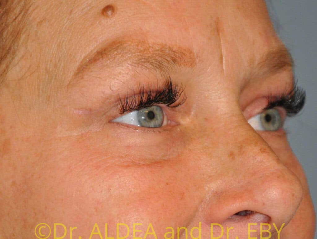 After Image: Blepharoplasty #075 - right-front-oblique