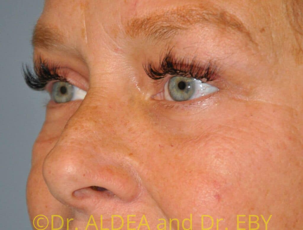 After Image: Blepharoplasty #075 - left-front-oblique