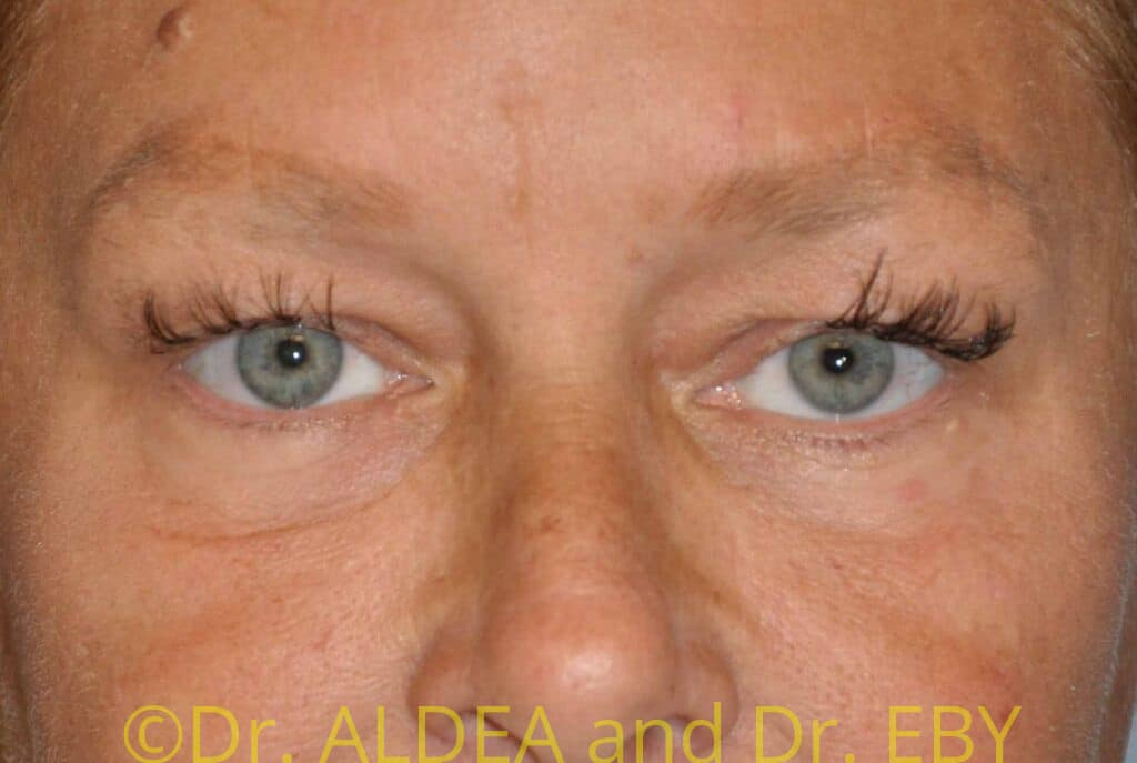 Before Image: Blepharoplasty #075 - front
