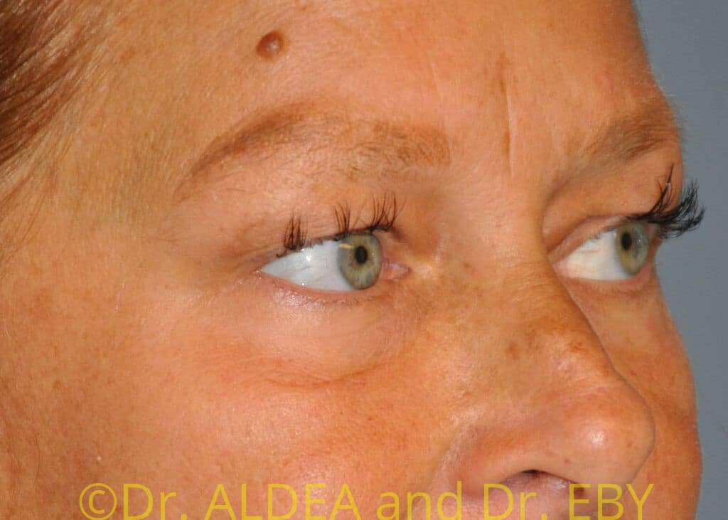 Before Image: Blepharoplasty #075 - right-front-oblique