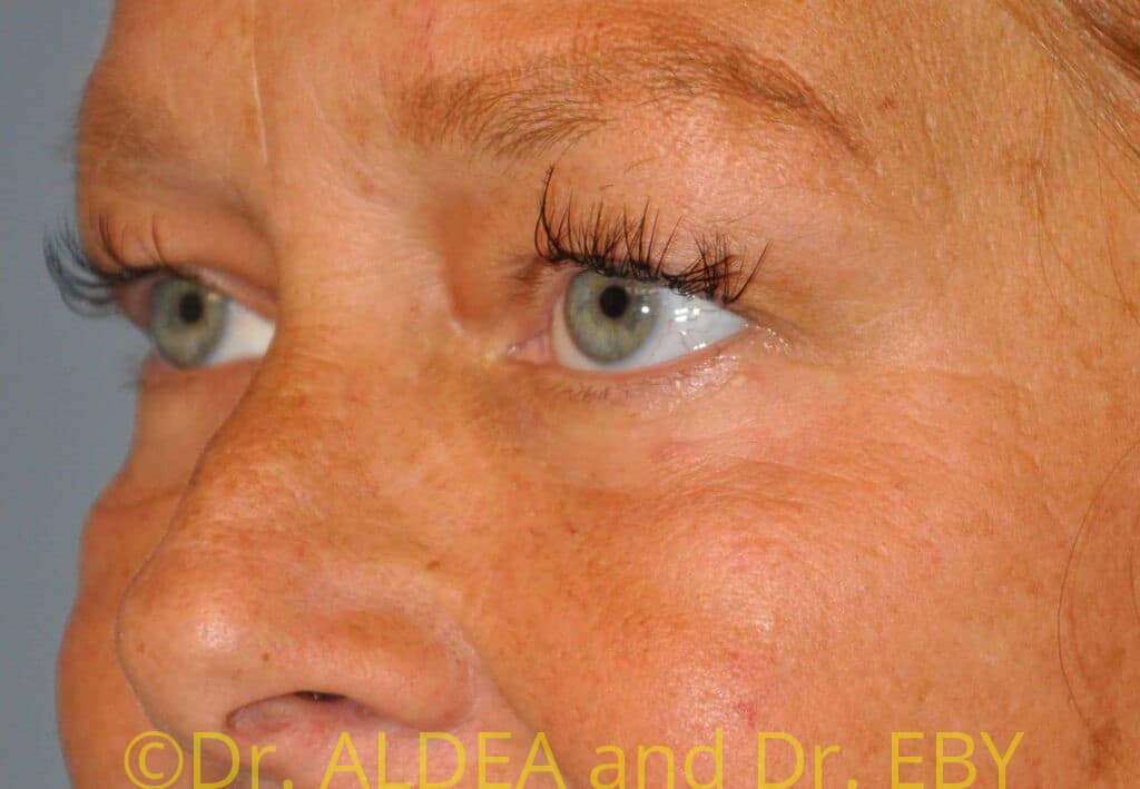 Before Image: Blepharoplasty #075 - left-front-oblique