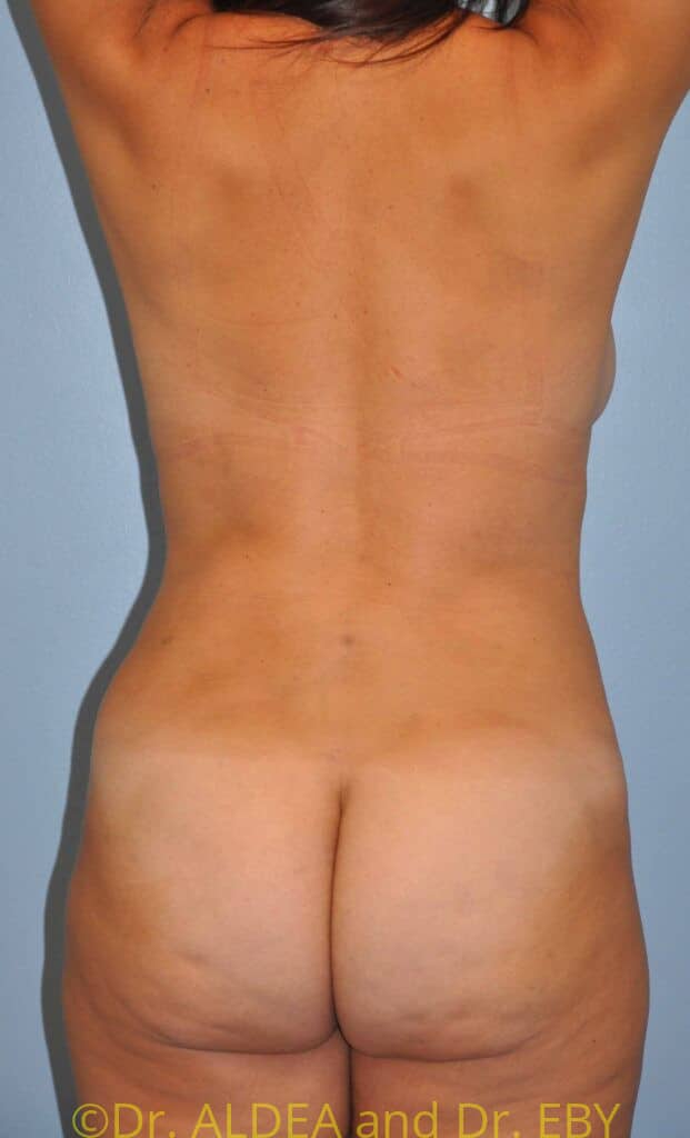 After Image: Back Scoop Liposuction #384 - back