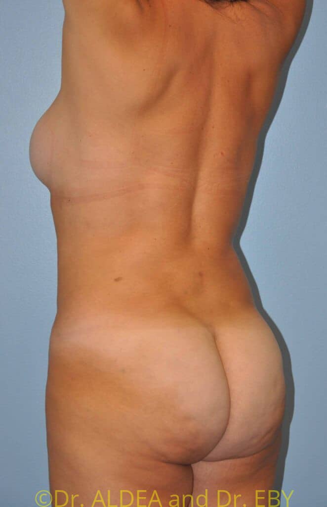 After Image: Back Scoop Liposuction #384 - left-back-oblique