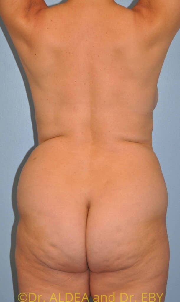 Before Image: Back Scoop Liposuction #384 - back