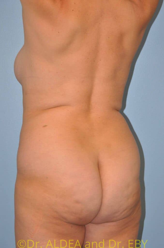 Before Image: Back Scoop Liposuction #384 - left-back-oblique