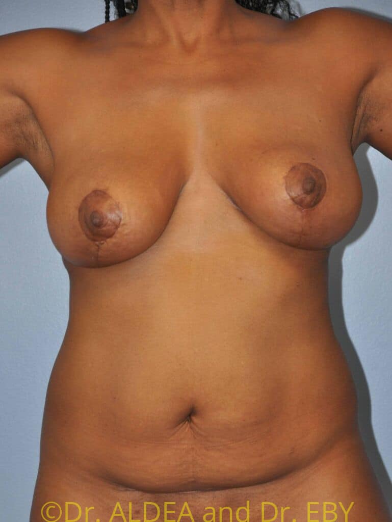 After Image: Short Scar Breast Lift (Mastopexy) #791 - front