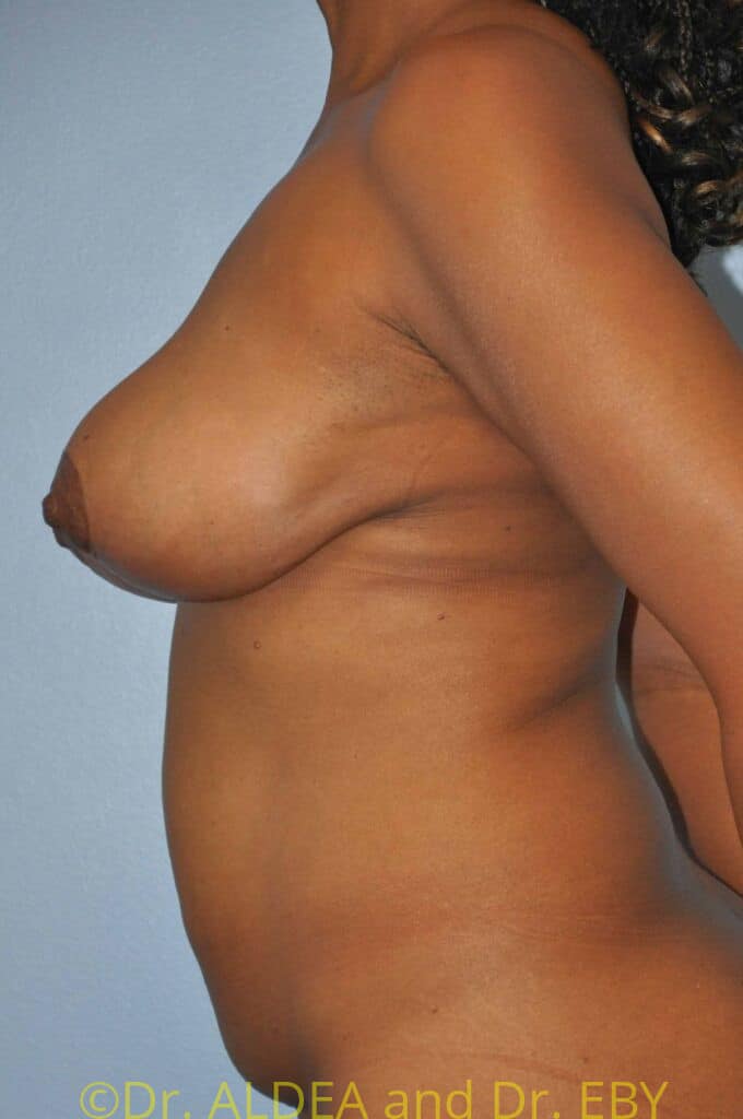 After Image: Short Scar Breast Lift (Mastopexy) #791 - left-side
