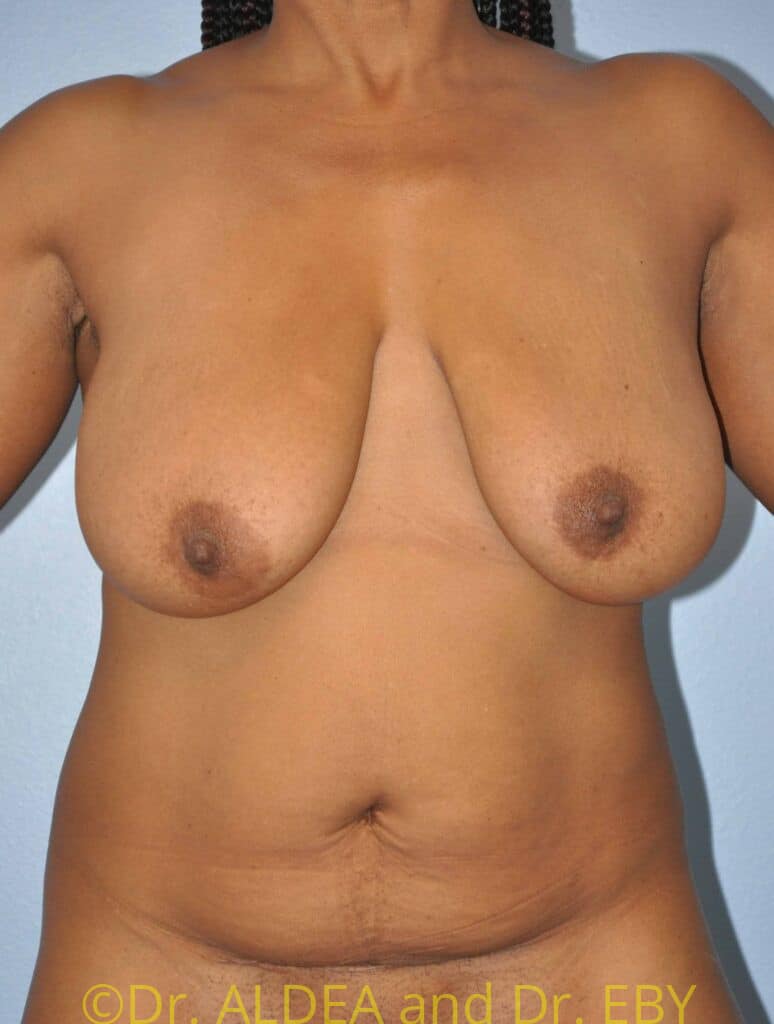 Before Image: Short Scar Breast Lift (Mastopexy) #791 - front