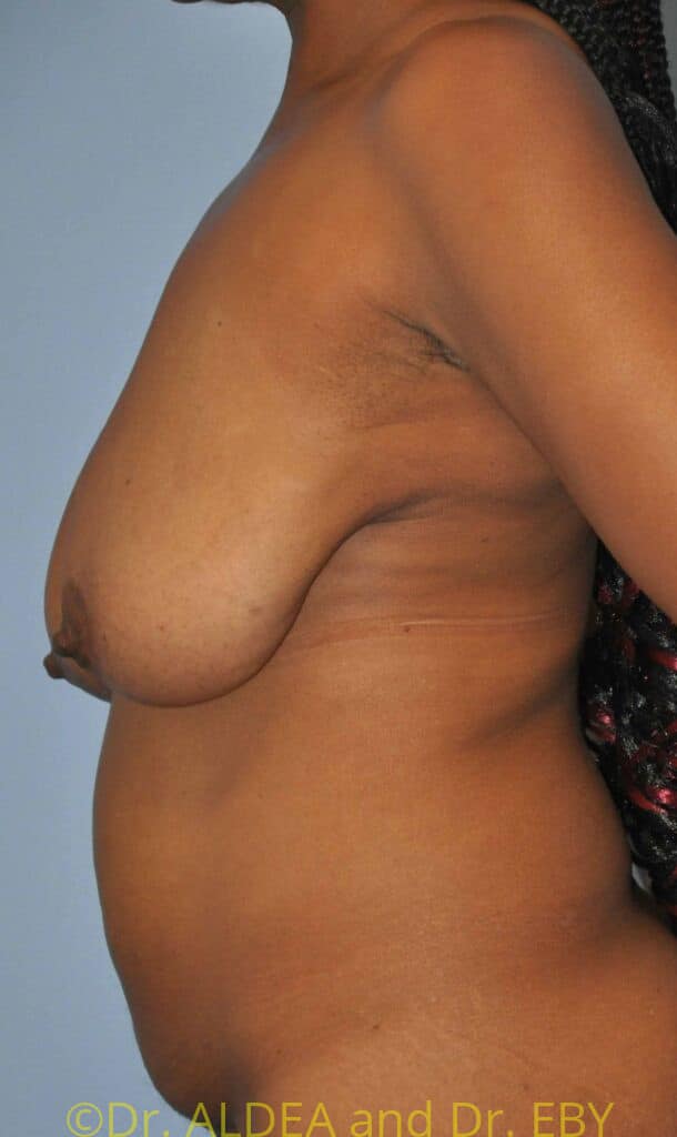 Before Image: Short Scar Breast Lift (Mastopexy) #791 - left-side
