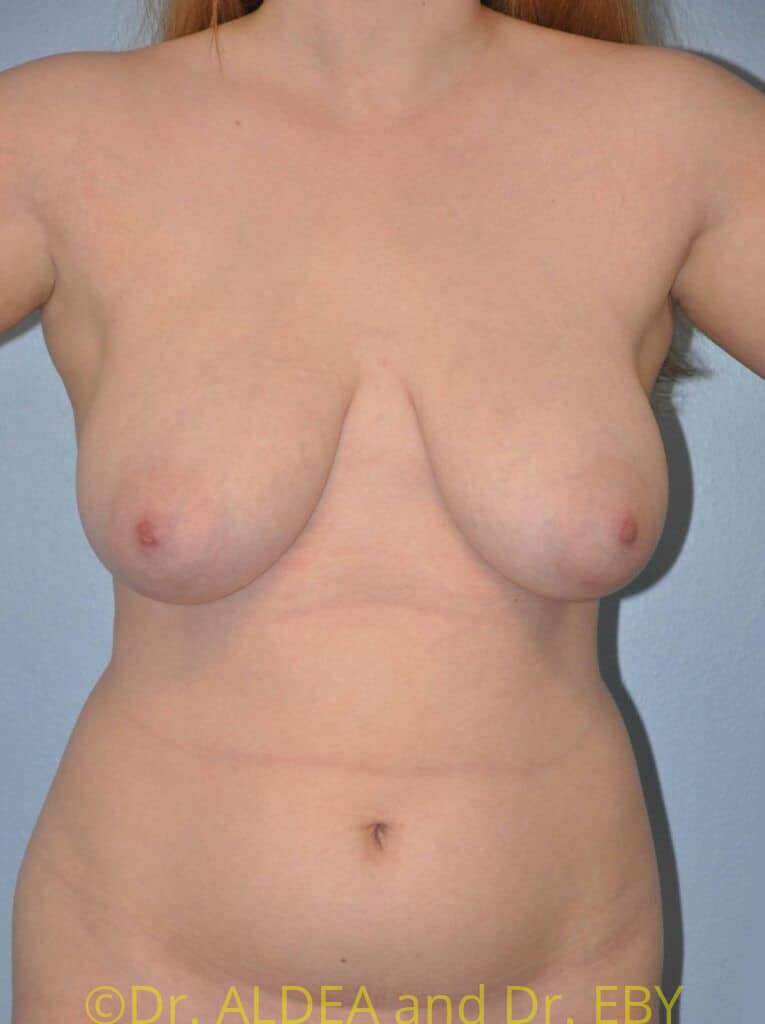 Before Image: Short Scar Breast Reduction #112 - front