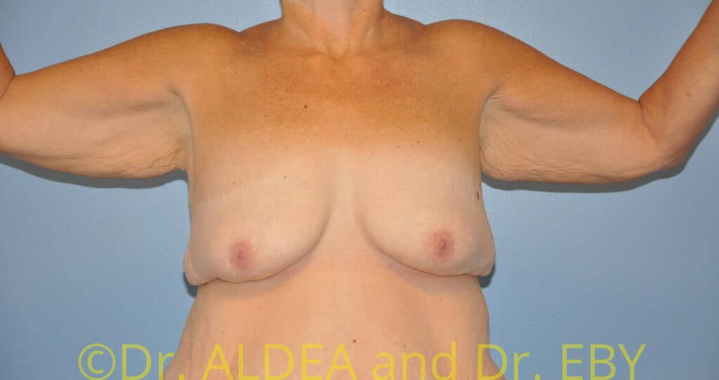 Before Image: Brachioplasty #716 - front