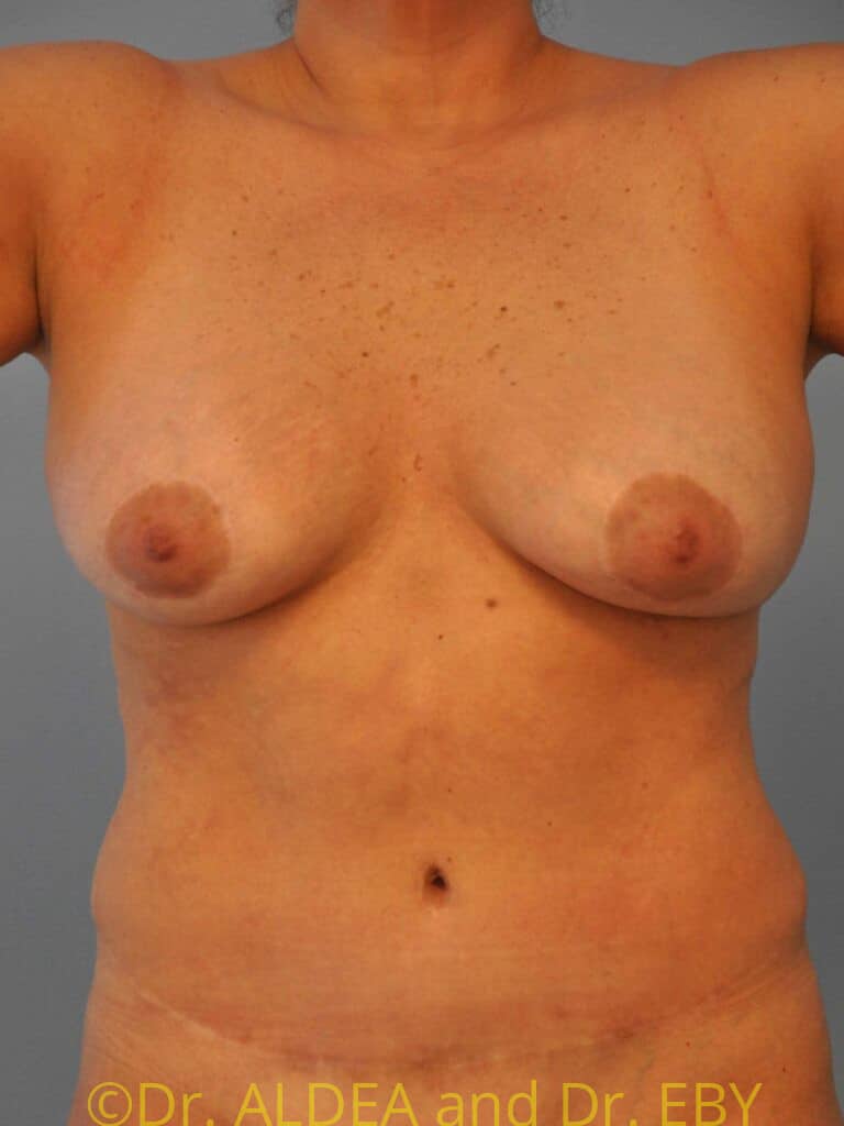 Before Image: Breast Implant Removal (Explantation) WITH a Lift #877 - front