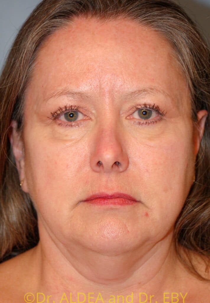 Before Image: Facelift #351 - front