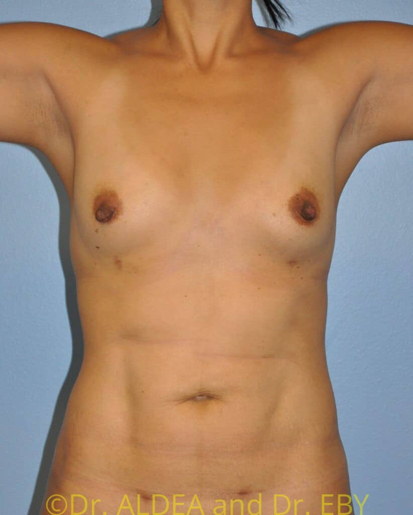 After Image: Fat Transfer to Breasts #265 - front