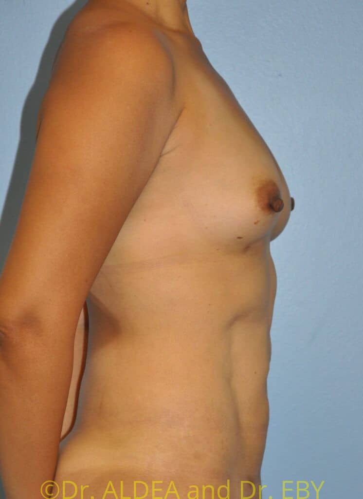 After Image: Fat Transfer to Breasts #265 - right-side