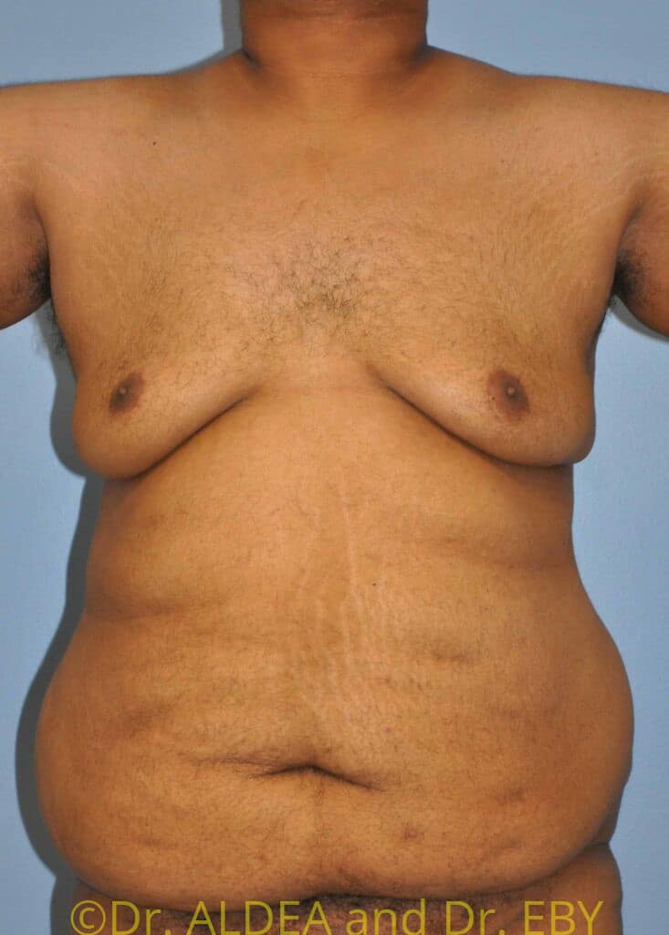 Before Image: Gynecomastia #517 - front