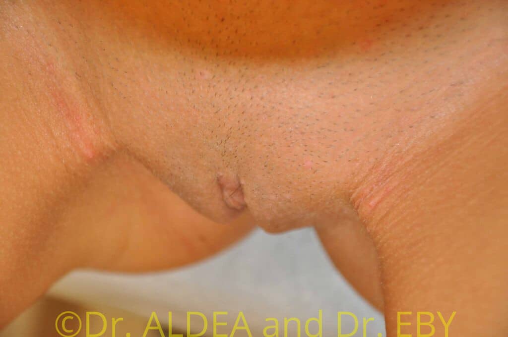 After Image: Labiaplasty #149 - front