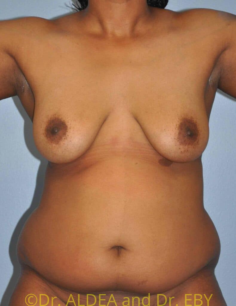 Before Image: Liposuction #802 - front