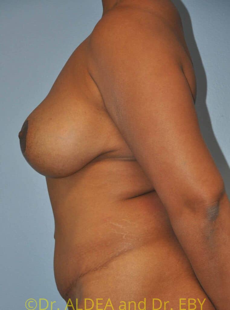 After Image: Mommy Makeover #166 - left-side