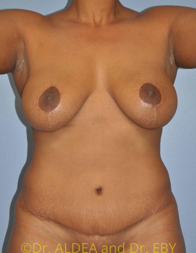 After Image: Mommy Makeover #166 - front