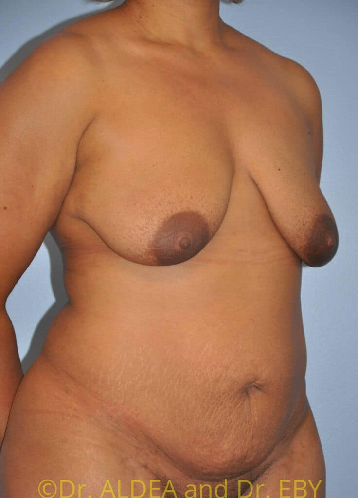 Before Image: Mommy Makeover #166 - right-front-oblique