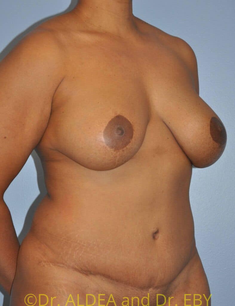After Image: Mommy Makeover #166 - right-front-oblique