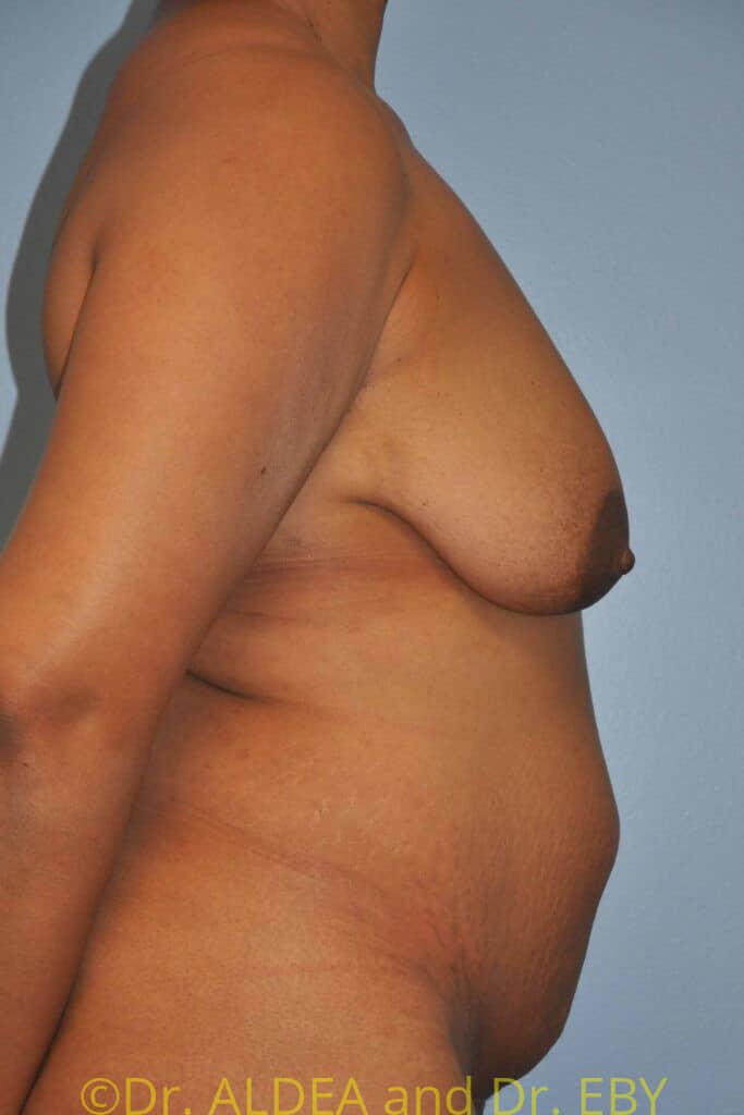 Before Image: Mommy Makeover #166 - right-side