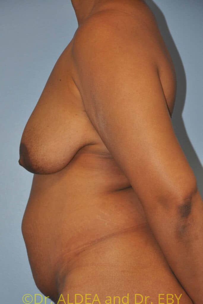 Before Image: Mommy Makeover #166 - left-side
