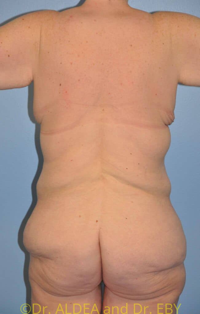 Before Image: Weight loss (MWL) Butt and Thigh Lift #375 - back