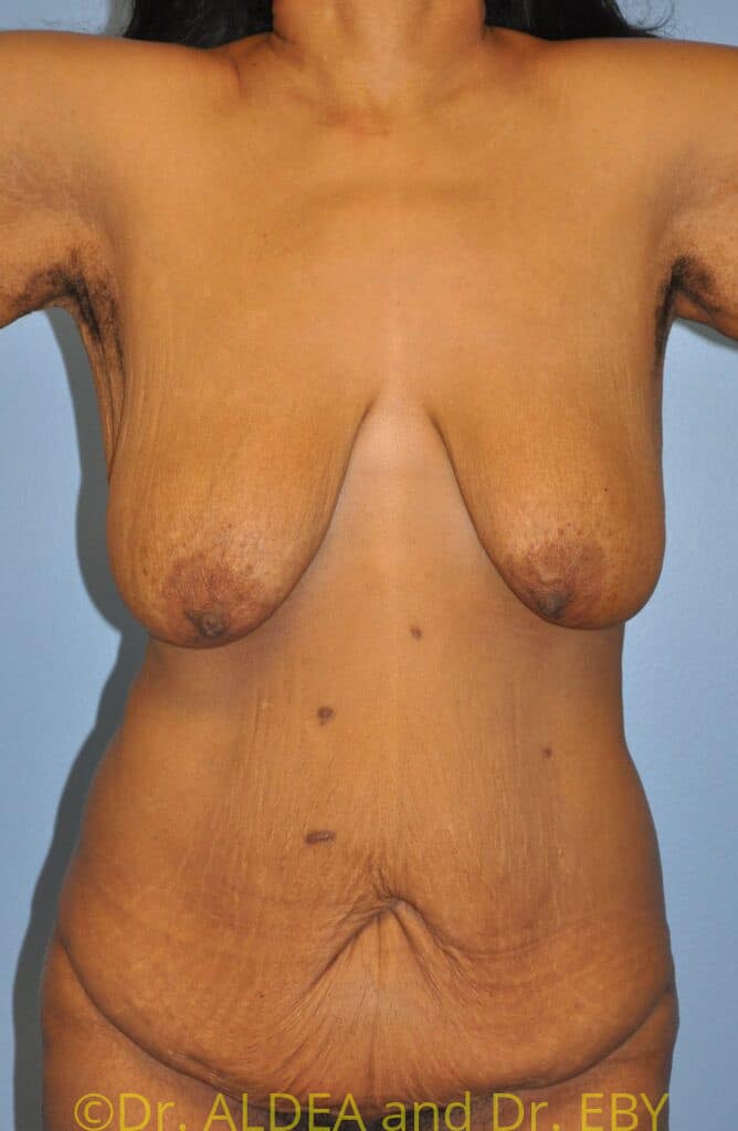 Before Image: Massive Weight Loss Tummy Tuck #609 - front