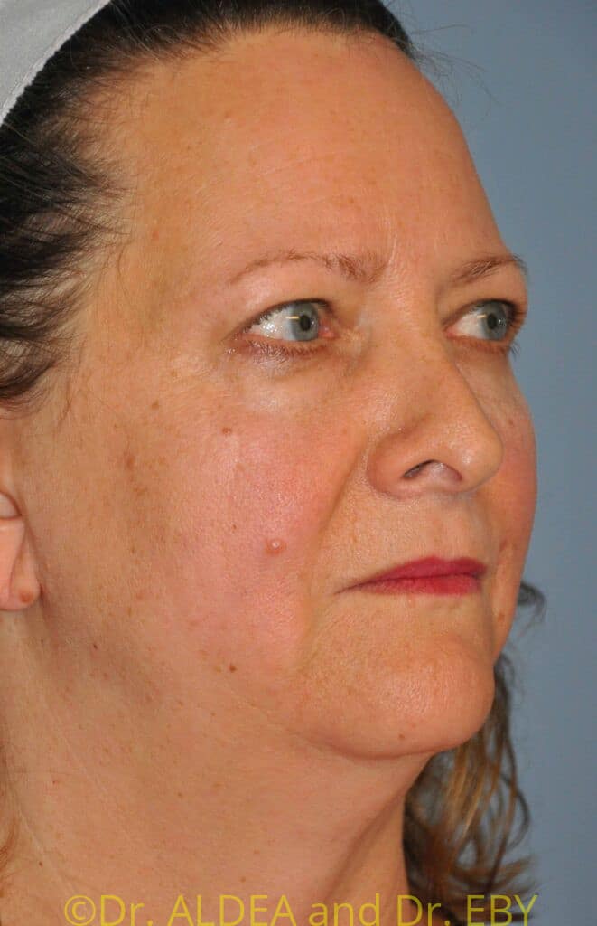 Before Image: Neck Liposuction #877 - right-front-oblique