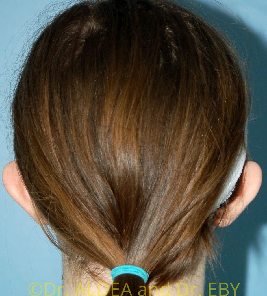 Before Image: Otoplasty (Prominent Ear Correction) #505 - back