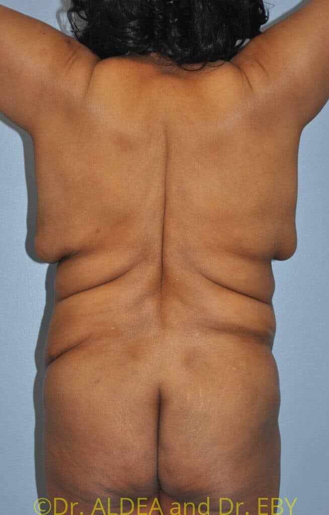 Before Image: Weight loss Upper Back (Bra Line) Lift (UBL) #299 - back