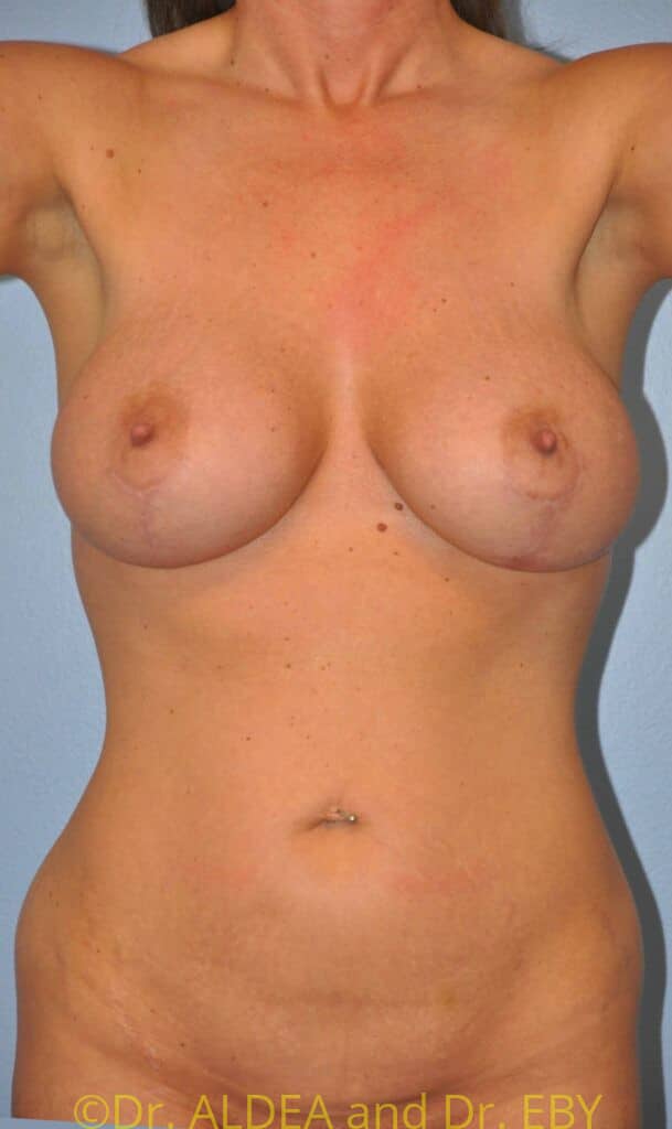 After Image: Breast Augmentation w/ Lift #900 - front