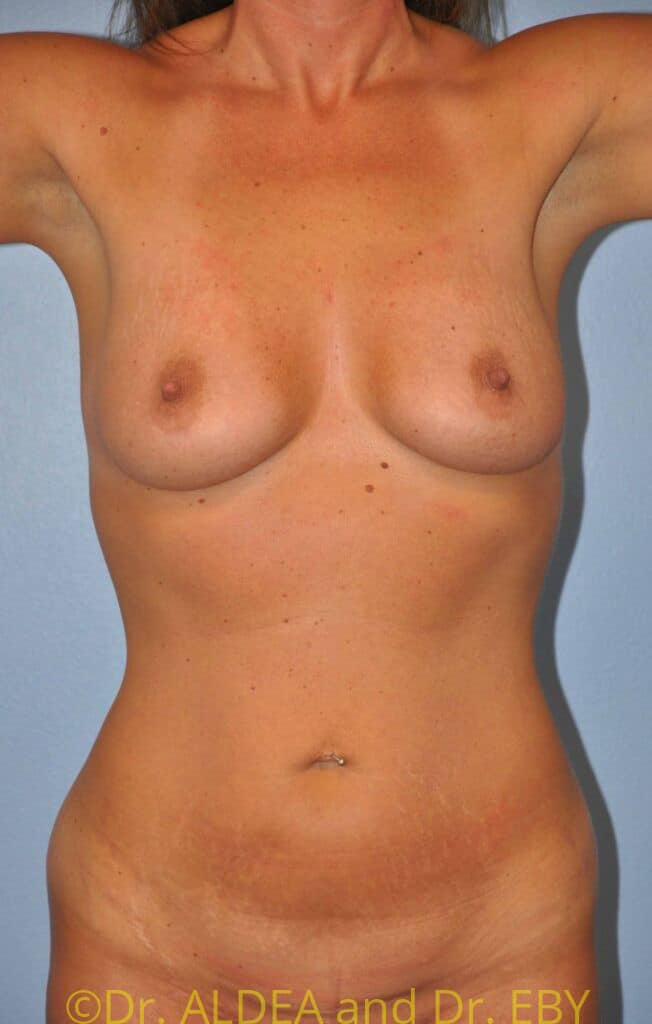 Before Image: Breast Augmentation w/ Lift #900 - front